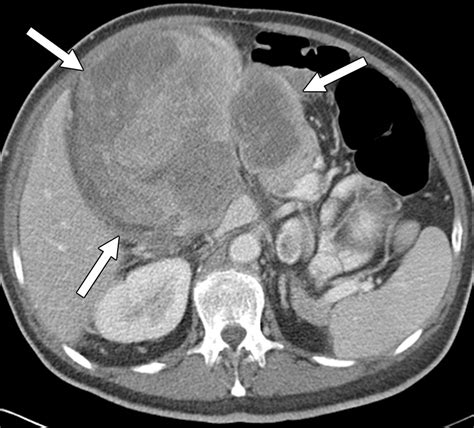 Fat Containing Retroperitoneal Lesions Imaging Characteristics Localization And Differential