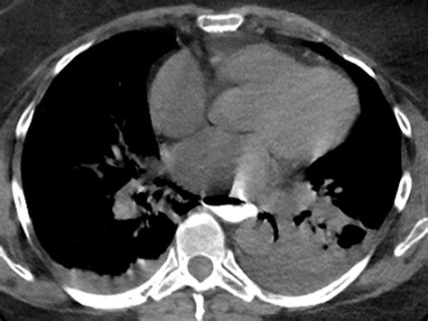 CT Esophagography For Evaluation Of Esophageal Perforation RadioGraphics