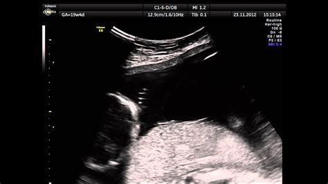 Diamniotica Monochorionic Twin Pregnancy Ultrasound Youtube