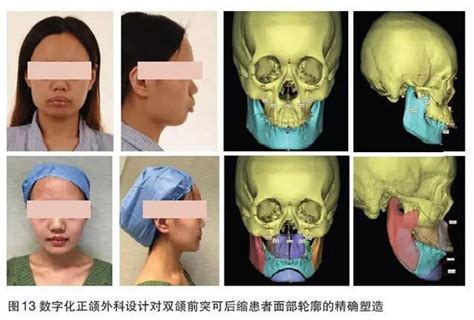 三维全息数字化正颌外科手术设计