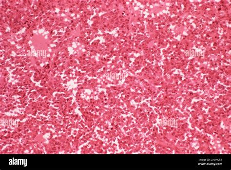 Lung Cancer Light Micrograph Of A Section Through Lung Tissue Showing