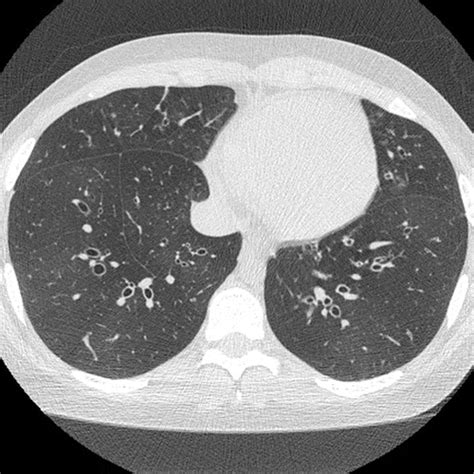 Bronchiolitis A Practical Approach For The General Radiologist