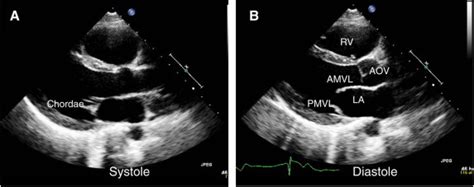 Anterior Mitral Leaflet