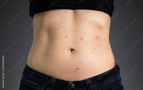 Foto Stock Heat Rash On Stomach Of Woman Fit Female Torso With Prickly