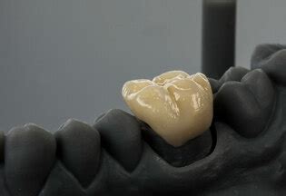 Descubre Las Pr Tesis Dentales Esquel Ticas Todo Lo Que Necesitas