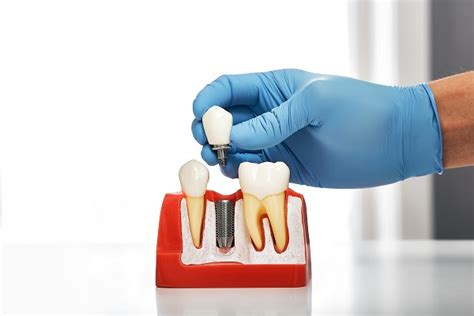 4 Things You Should Know About Dental Implants Posts