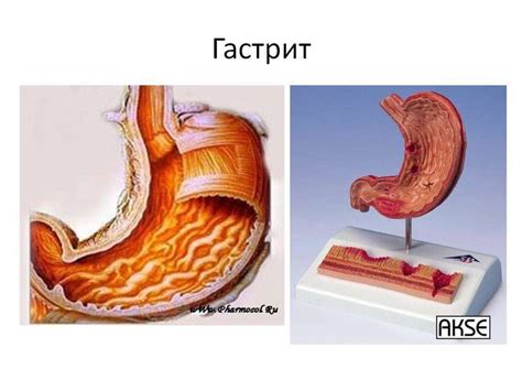 Гастрит - запалення слизової (внутрішній) оболонки стінки шлунка ...