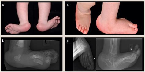 Understanding Congenital Vertical Talus Orthopaedics And Trauma