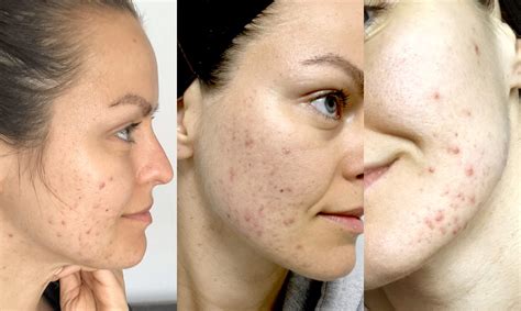 My Journey From Adult Acne To Clear Skin Lena Wild