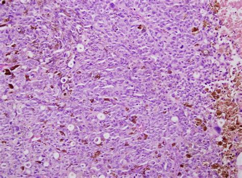 Pathology Outlines Oral Mucosal Melanoma