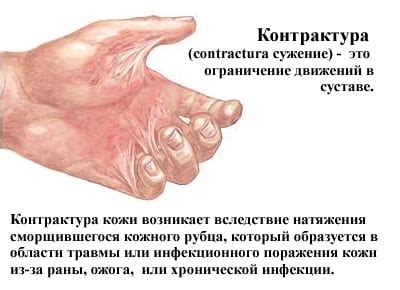 Какими бывают контрактуры, как их лечить: симптомы, способы диагностики ...