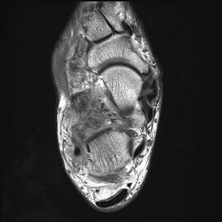 Extra Articular Lateral Hindfoot Impingement Image Radiopaedia Org