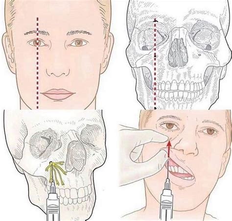 Infraorbital Nerve Lockdown Anatomia Denti