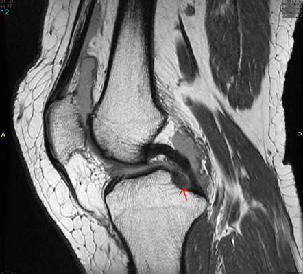 Root Tear Of Medial Meniscus Radiology Case Radiopaedia Org | Sexiz Pix