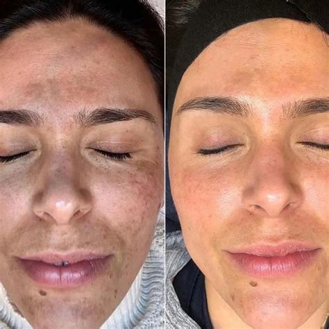 List 90 Pictures Chemical Peels Before And After Pictures Stunning