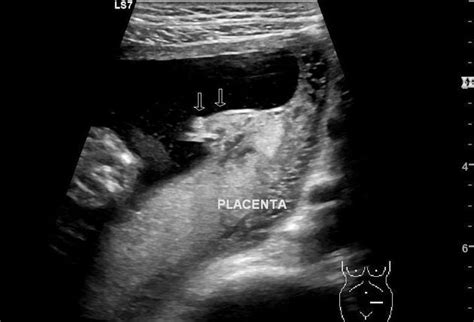 Circumvallate Placenta Radiology Case Ultrasound Placenta Medical Ultrasound