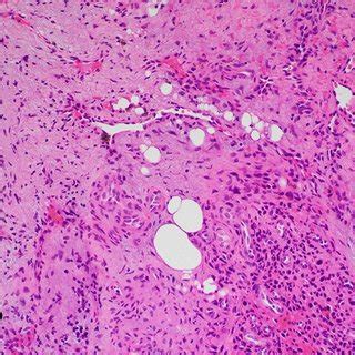 Representative H E Photomicrographs From Case Showing An Atypical