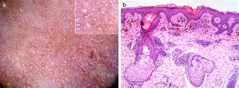 Figure From Dermoscopy Of Erythromelanosis Follicularis Faciei Et