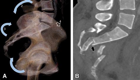 Ct Of Sacral Fractures Classification Systems And Management Radiographics