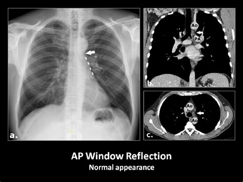 Figure 9 From Mediastinal Lines Stripes And Interfaces On Pa Chest Radiograph With Ct