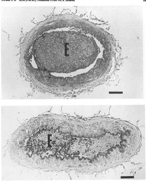 Figure 4 From Artery To Artery Embolism From A Thrombus Formed In