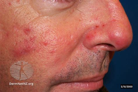 Telangiectasia Rosacea