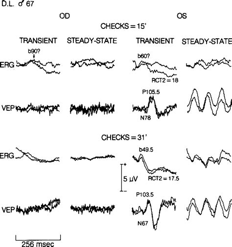 Figure From Simultaneous Recording Of Pattern Electroretinogram And