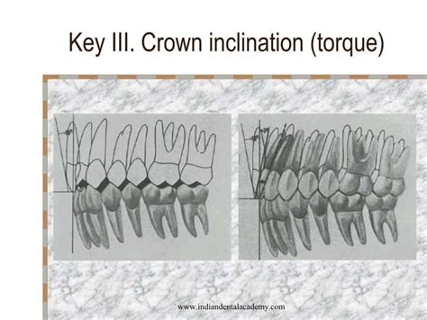 Andrews 6 Keys Of Normal Occlusion Certified Fixed Orthodontic Courses By Indian Dental Academy