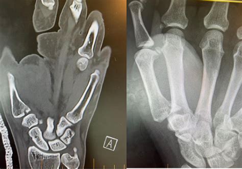 Screw And Suspension Fixation For Bennett Fractures Journal Of Hand