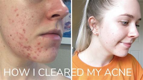 How I Cleared My Acne Youtube