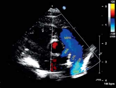 Patent Ductus Arteriosus And Aortopulmonary Window Thoracic Key