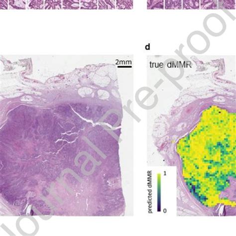 Example Histology Slides For Msi Dmmr And Mss Pmmr Colorectal Tumors