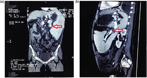 Abdominal Enhanced Computed Tomography And Computed Tomography