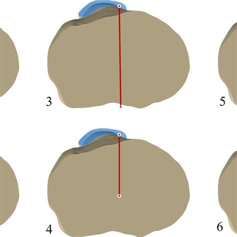 Tt Pcl The Tt Pcl Distance Was Determined As The Mediolateral Distance