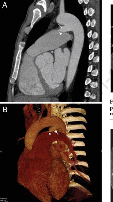 Figure 2 From Large Patent Ductus Arteriosus In An Adult Complicated By Pulmonary Endarteritis