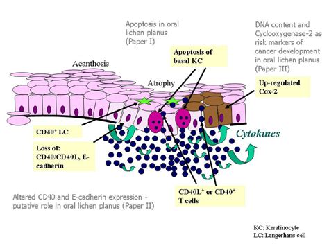 Lichen Planus Histology