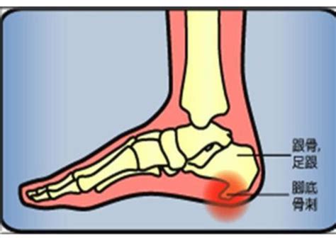 女子脚后跟长骨刺，脚一挨地疼到骨头里！5个办法可有效缓解足跟痛 凤凰网