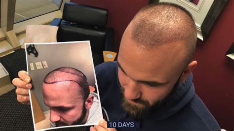 Fue Robotic Hair Transplant Procedure And First 10 Days After Youtube