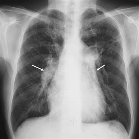 Imaging Of Pulmonary Hypertension Chest