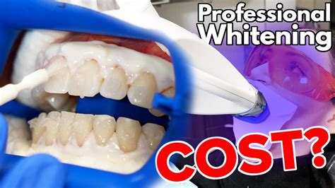 How Much Does Professional Teeth Whitening Cost Youtube