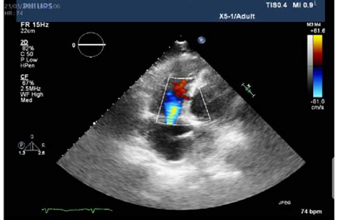 A Large Posterobasal Ventricular Septal Defect As Seen On Transthoracic