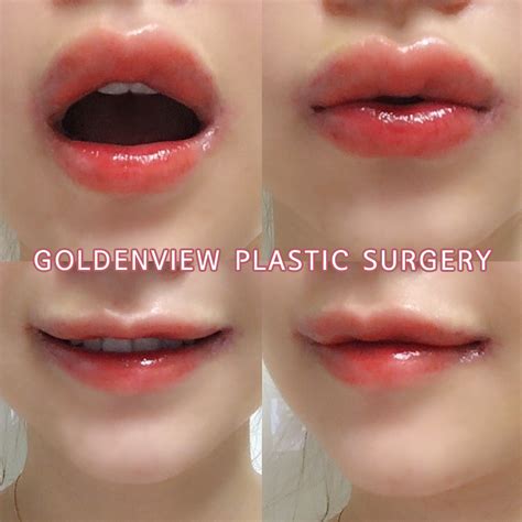 Goldenview Plastic Surgery Mouth Corner Lift Is Korea Lip Plastic