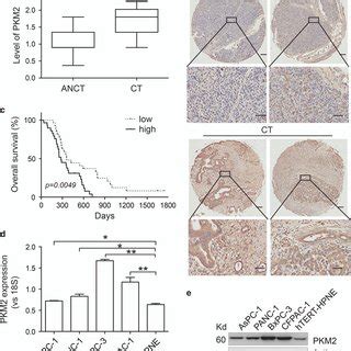 PKM2 Is Highly Expressed In Pancreatic Cancer Samples And Predicts Poor