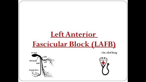 Left Anterior Fascicular Block Dr Akif Baig Youtube