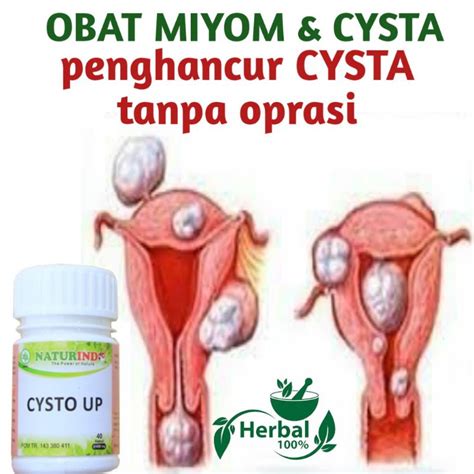 Jual OHB Obat Kista Miom Ovarium Cysta Myom Bartholin Ganglion Benjolan