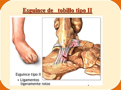 Tratamiento Del Esguince De Tobillo De Grado Goldepenalti