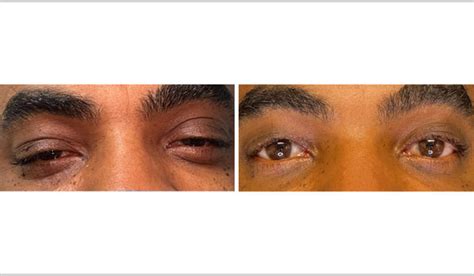 Frontalis Sling Beach Eye Care Lasik And Vision Correction Coastal
