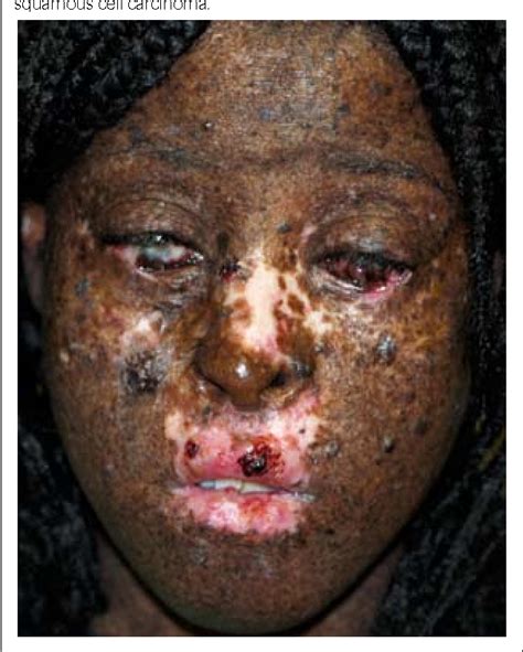 Xeroderma Pigmentosum A Case Report And Review Of The Literature