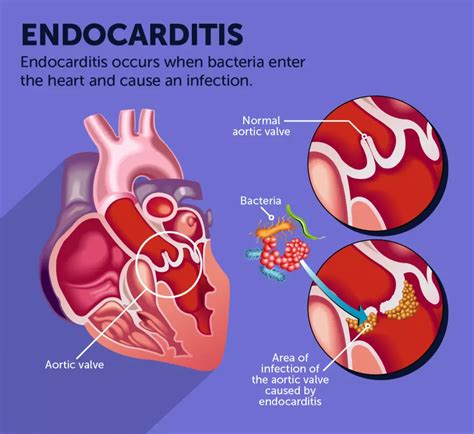 Endocarditis: Symptoms, Testing, and Treatment | MyHeartDiseaseTeam