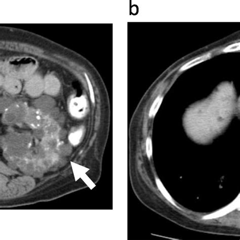 Radiologic Findings In The Proband A Unenhanced Computed Tomography